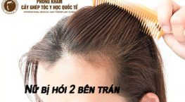 nữ bị hói 2 bên trán
