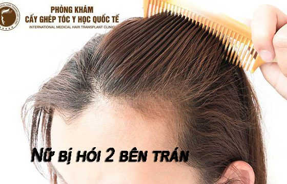 nữ bị hói 2 bên trán