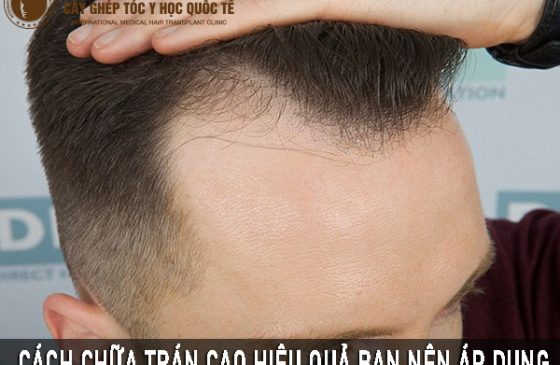 chữa trán cao