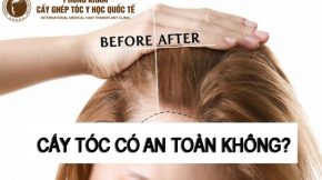 cấy tóc có an toàn không