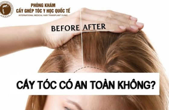cấy tóc có an toàn không