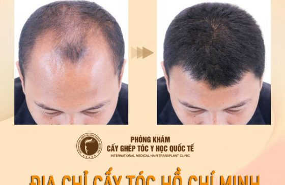 cấy tóc hồ chí minh