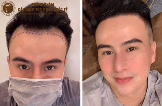 cấy tóc cho người hói