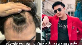 cấy tóc trị hói