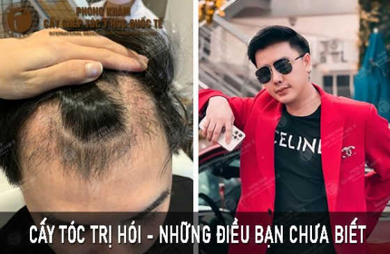 cấy tóc trị hói