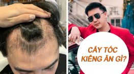 cấy tóc xong kiêng ăn gì