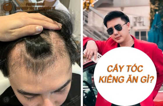 cấy tóc xong kiêng ăn gì