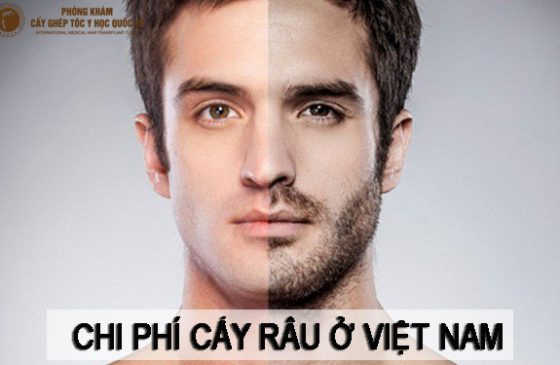 chi phí cấy râu