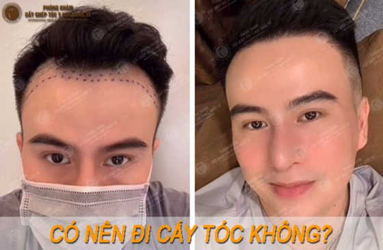 có nên đi cấy tóc không