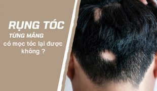 Giải đáp: Tóc rụng từng mảng có mọc lại không?