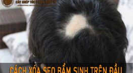 sẹo bẩm sinh trên đầu