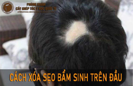 sẹo bẩm sinh trên đầu