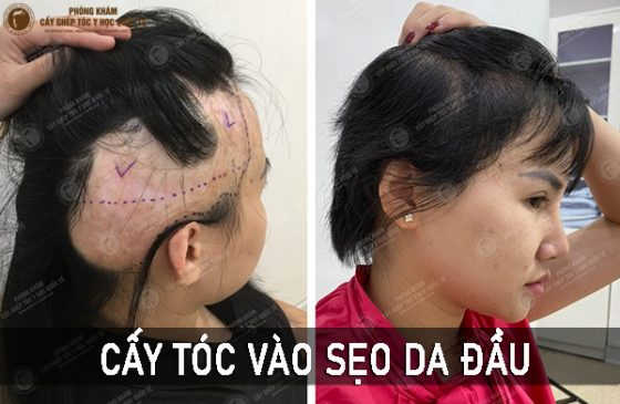 cấy tóc vào sẹo