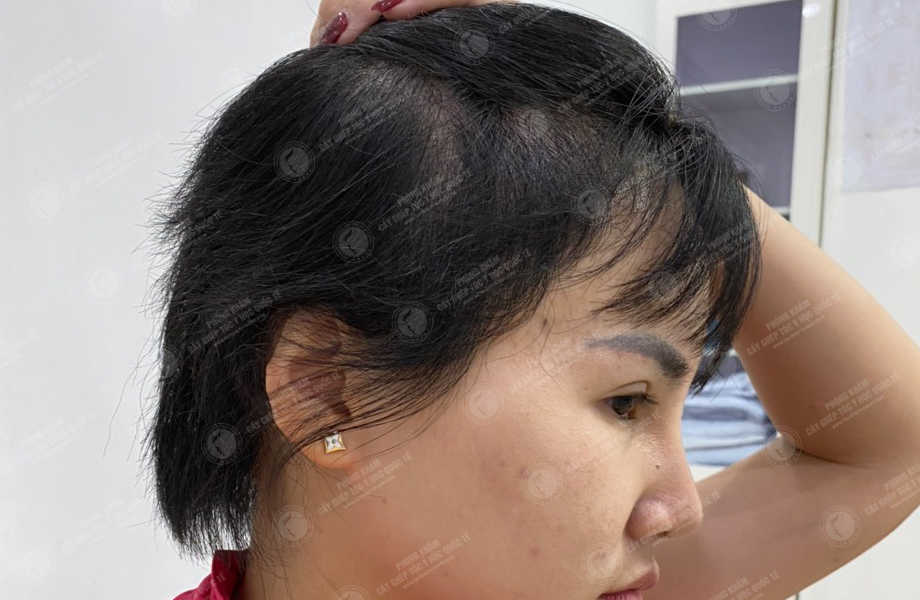 Trần Thùy Trang - Cấy tóc trên sẹo 3