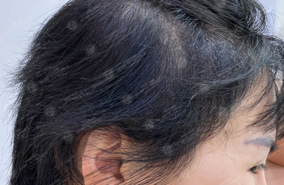 Trần Thùy Trang - Cấy tóc trên sẹo 2