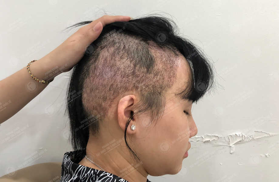 Trần Thùy Trang - Cấy tóc trên sẹo 6
