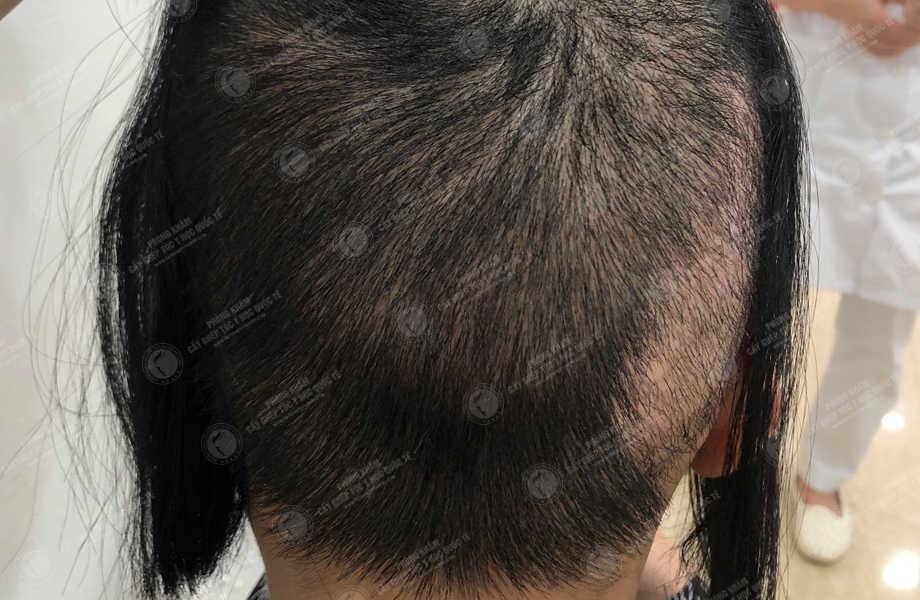 Trần Thùy Trang - Cấy tóc trên sẹo 5