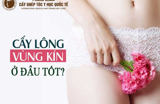 Cấy lông mu ở đâu tốt
