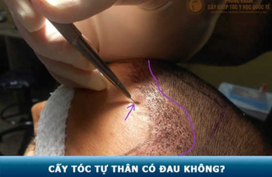 cấy tóc có đau không