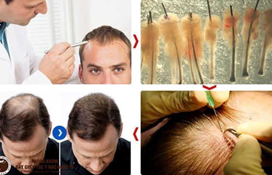 cấy tóc như thế nào
