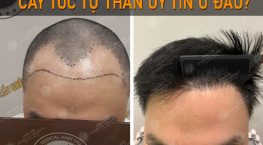 cấy tóc tự thân uy tín