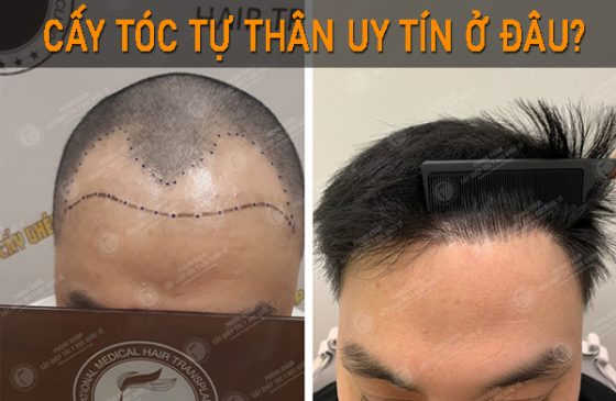 cấy tóc tự thân uy tín