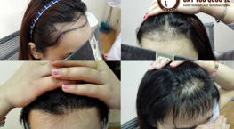 cấy tóc vào trán