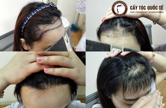 cấy tóc vào trán