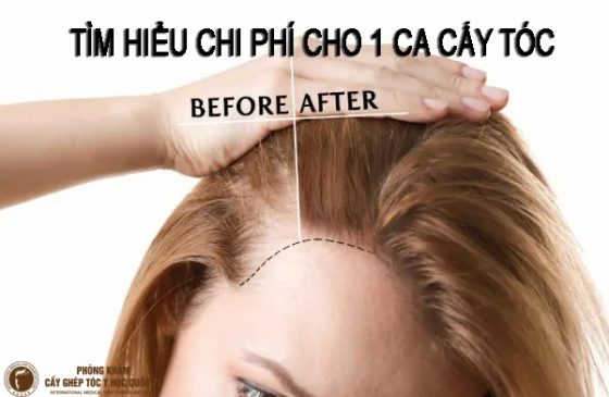 chi phí cấy tóc tự thân, cấy tóc tự thân bao nhiêu tiền, chi phí cấy ghép tóc tự thân, cấy tóc tự thân hết bao nhiêu tiền, cấy tóc tự thân giá bao nhiêu,
