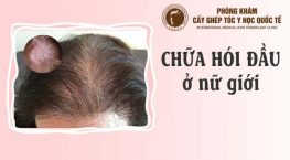 cách chữa hói đầu ở nữ giới