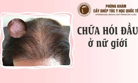 cách chữa hói đầu ở nữ giới
