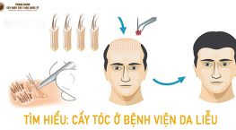 chi phí cấy tóc bệnh viện da liễu, cấy tóc tại bệnh viện da liễu trung ương, cấy tóc ở bệnh viện da liễu trung ương, cấy tóc bệnh viện da liễu tp hcm, cấy tóc bệnh viện da liễu, cấy tóc ở bệnh viện da liễu tphcm, bệnh viện da liễu có cấy tóc không, bệnh viện da liễu trung ương có cấy tóc không, cấy tóc ở bệnh viện da liễu bao nhiêu tiền,