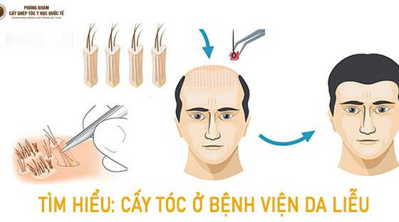 chi phí cấy tóc bệnh viện da liễu, cấy tóc tại bệnh viện da liễu trung ương, cấy tóc ở bệnh viện da liễu trung ương, cấy tóc bệnh viện da liễu tp hcm, cấy tóc bệnh viện da liễu, cấy tóc ở bệnh viện da liễu tphcm, bệnh viện da liễu có cấy tóc không, bệnh viện da liễu trung ương có cấy tóc không, cấy tóc ở bệnh viện da liễu bao nhiêu tiền,