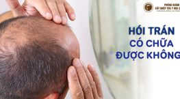 hói trán có chữa được không