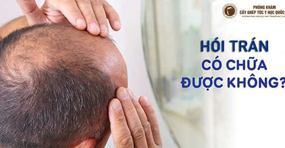 hói trán có chữa được không