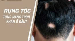 rụng tóc từng mảng tròn khám ở đâu