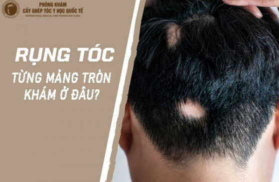 rụng tóc từng mảng tròn khám ở đâu