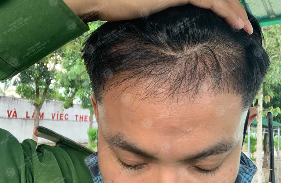 Nguyễn Văn Dự - Cấy tóc đường chữ M 12