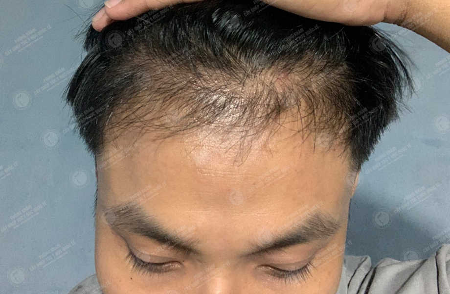 Nguyễn Văn Dự - Cấy tóc đường chữ M 13