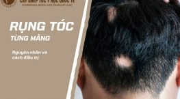 kinh nghiệm chữa rụng tóc từng mảng