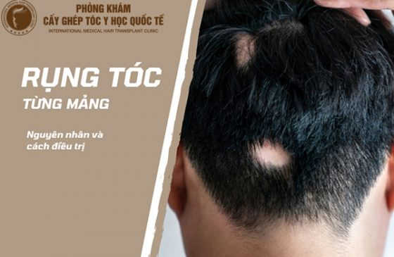 kinh nghiệm chữa rụng tóc từng mảng