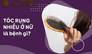 Tìm hiểu rụng tóc nhiều ở nữ là bệnh gì và phương pháp điều trị hiệu quả