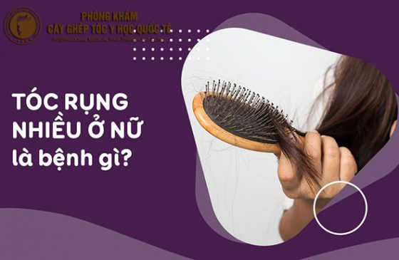 rụng tóc nhiều ở nữ là bệnh gì