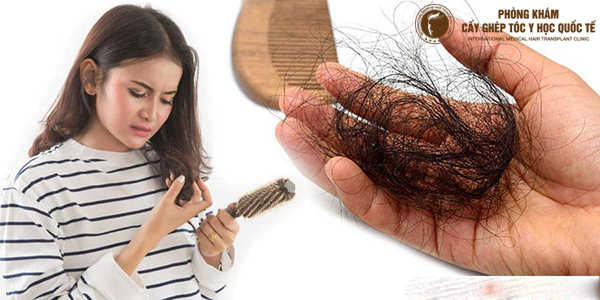 rụng tóc nhiều ở nữ là bệnh gì