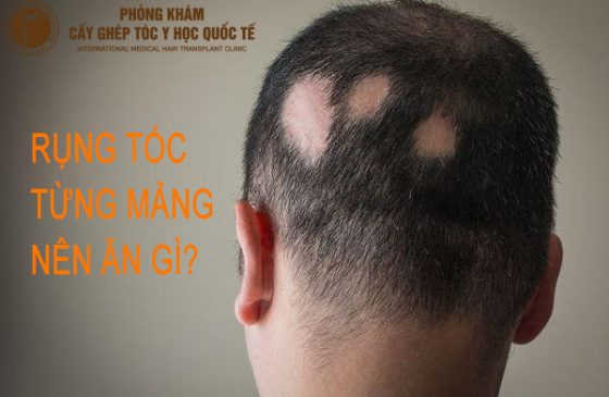 rụng tóc từng mảng nên ăn gì