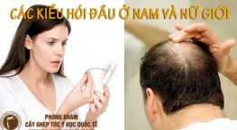 các kiểu hói đầu