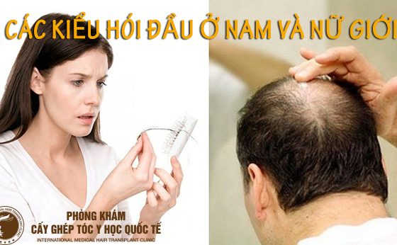 các kiểu hói đầu