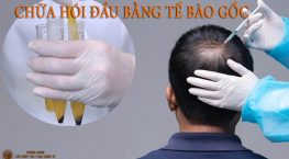 chữa hói đầu bằng tế bào gốc