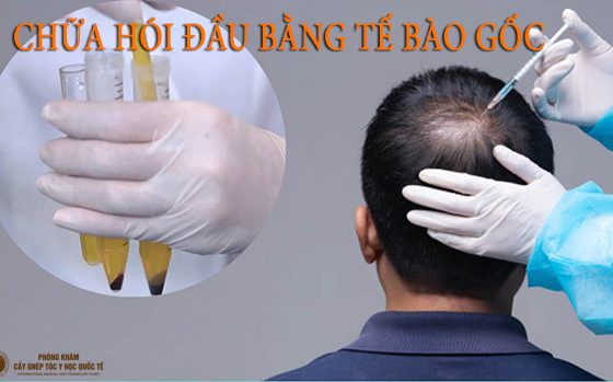 chữa hói đầu bằng tế bào gốc