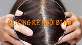 đường rẽ ngôi bị hói